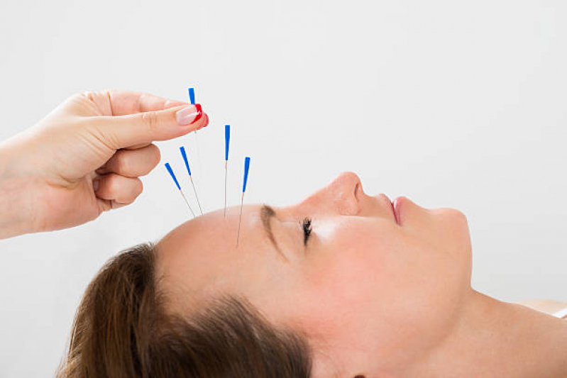acupuntura-facial