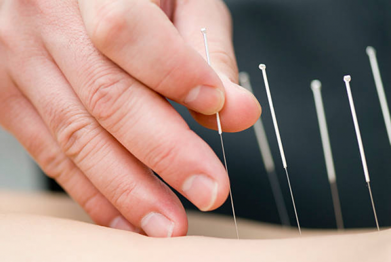 acupuntura-para-ansiedade