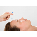 acupuntura para dor de cabeça valores Águas Claras