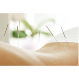 sessão de acupuntura para dor nas costas Ceilândia